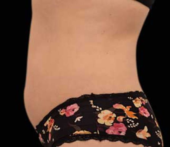 Patient 10 after photo