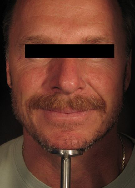 Patient 1 before photo