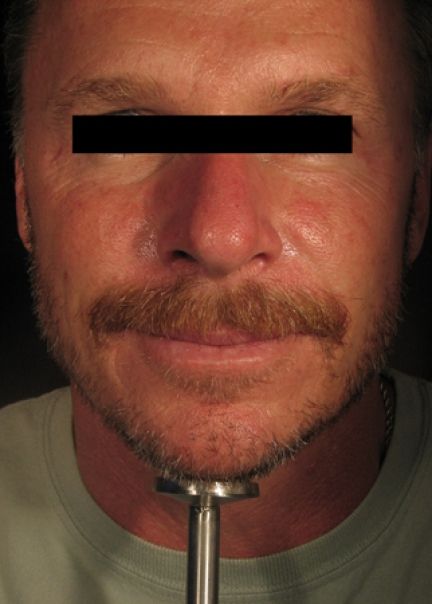 Patient 1 after photo