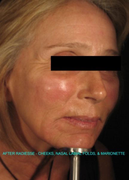Patient 2 after photo