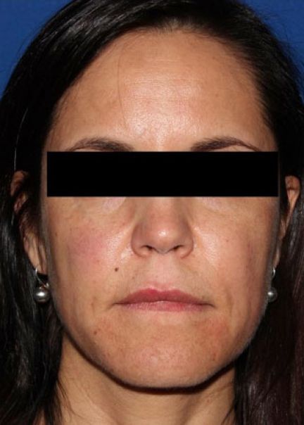 Patient 3 after photo