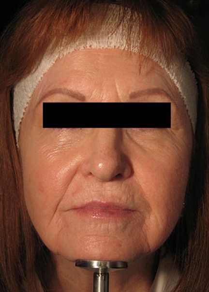 Patient 5 before photo