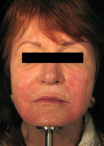 Patient 5 after photo
