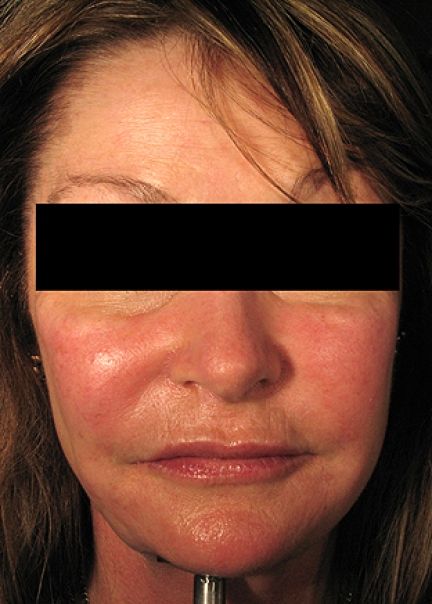 Patient 6 after photo