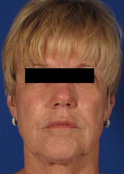 Patient 7 after photo