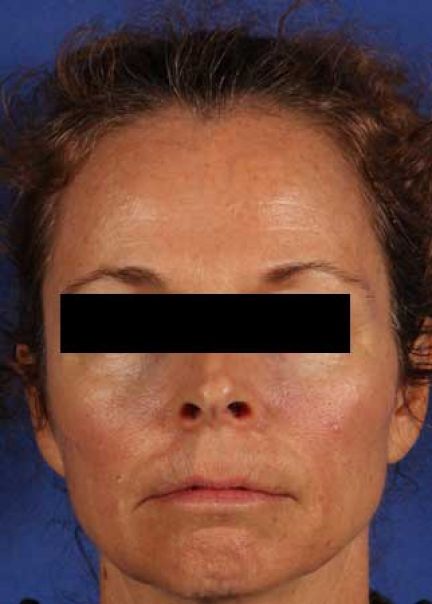Patient 8 after photo
