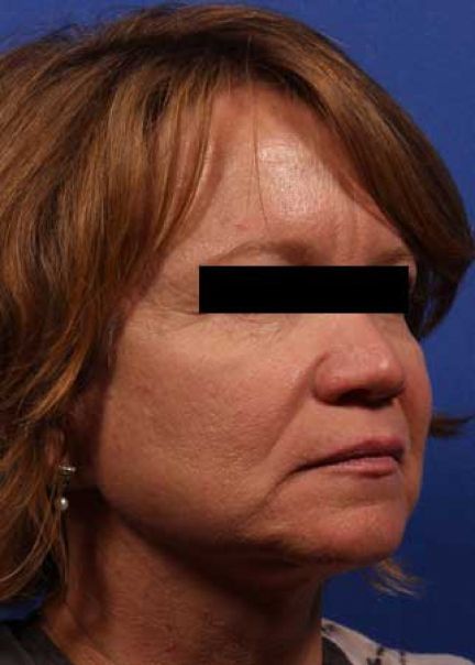 Patient 9 before photo