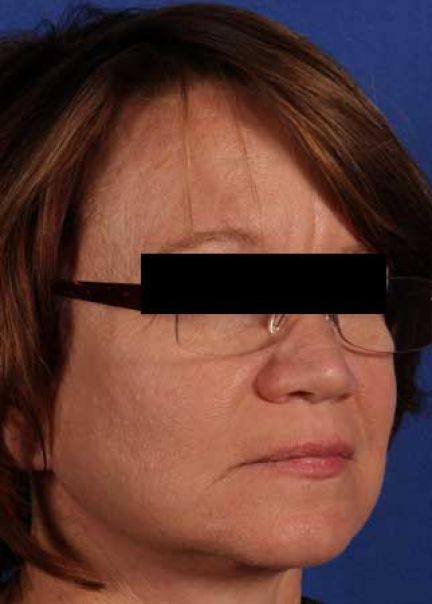 Patient 9 after photo
