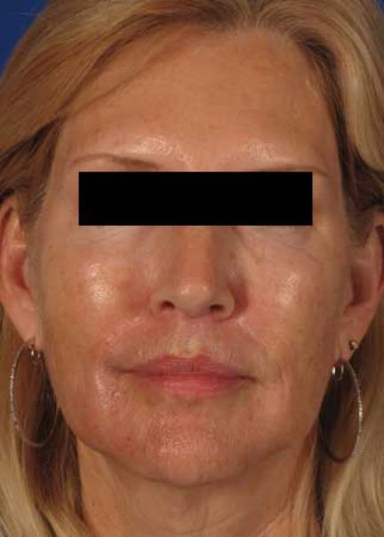 Patient 10 before photo