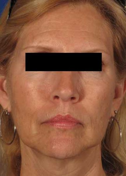 Patient 10 after photo