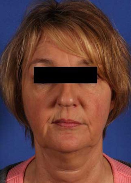 Patient 11 before photo