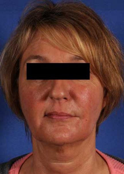 Patient 11 after photo