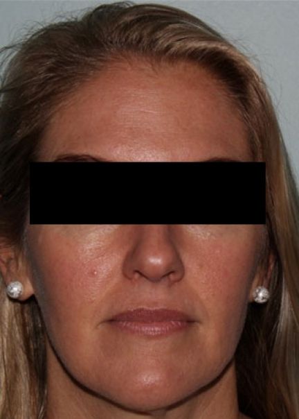 Patient 12 before photo