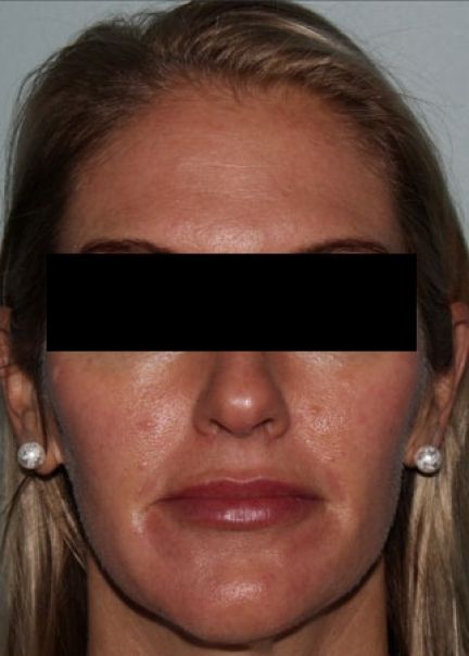 Patient 12 after photo