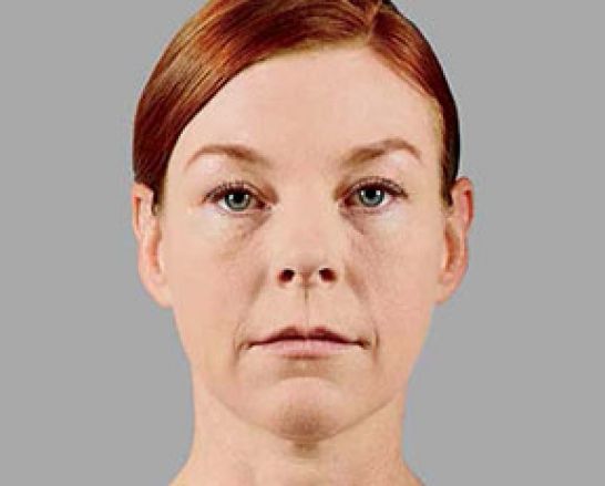 Patient 3 before photo