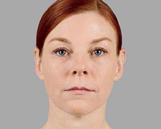 Patient 3 after photo