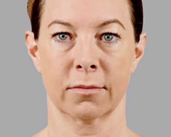 Patient 6 before photo