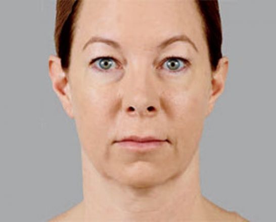 Patient 6 after photo