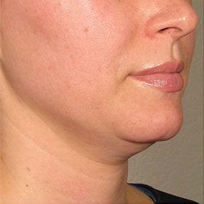 Patient 2 before photo