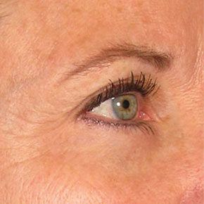 Patient 1 after photo