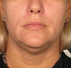 Patient 3 before photo