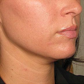 Patient 2 after photo