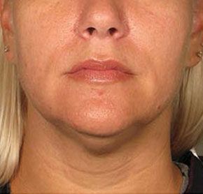 Patient 3 after photo