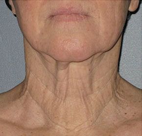 Patient 5 before photo