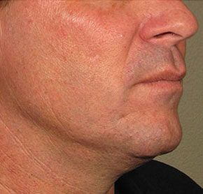 Patient 4 after photo