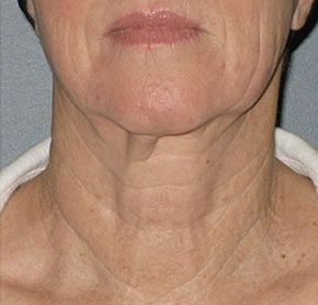 Patient 5 after photo