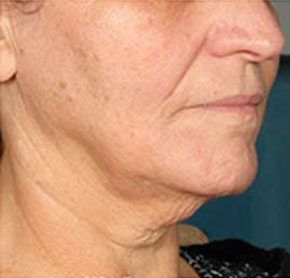 Patient 6 after photo