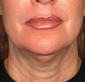 Patient 9 before photo