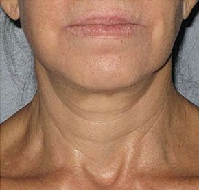 Patient 8 after photo