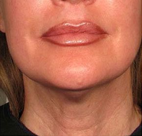 Patient 9 after photo