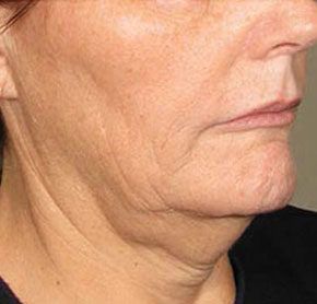 Patient 10 before photo