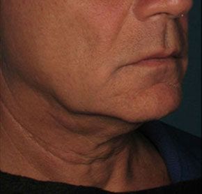 Patient 11 before photo