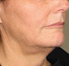 Patient 10 after photo