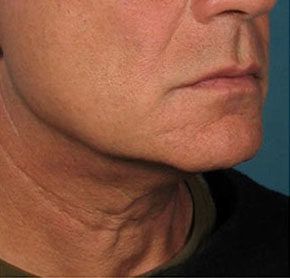 Patient 11 after photo