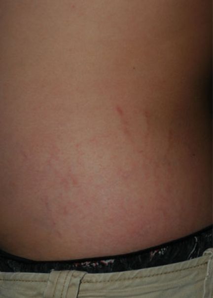 Patient 1 after photo