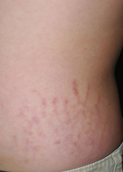 Patient 1 before photo