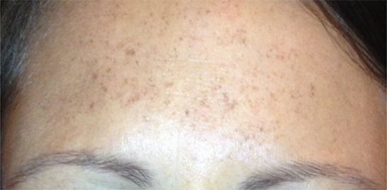Patient 1 before photo