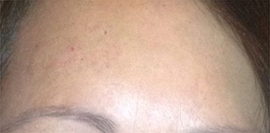 Patient 1 after photo