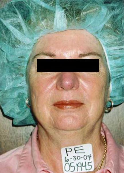 Patient 3 after photo
